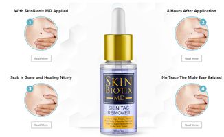 Benefits of Uses Skinbiotix MD Mole and Skin Tag Remover