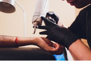 Zijn andere tattoo verwijderingsopties naast laser tattoo verwijdering veilig?