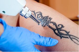 Tattoo removal gone wrong: Mislukte tatoeage verwijdering.